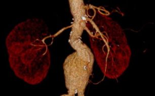 Cirurgias Arteriais