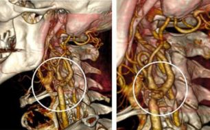 Cirurgia de Carótidas