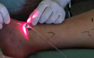 Tratamento com Laser para varizes