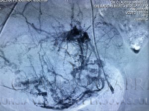 Angiografia por cateterismo super seletivo da Artéria Uterina esquerda identificando a circulação que nutre o mioma.